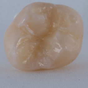 White or Composite fillings