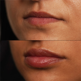 Lip Enhancement