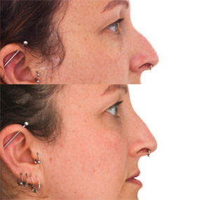 Non-Surgical Nose Job